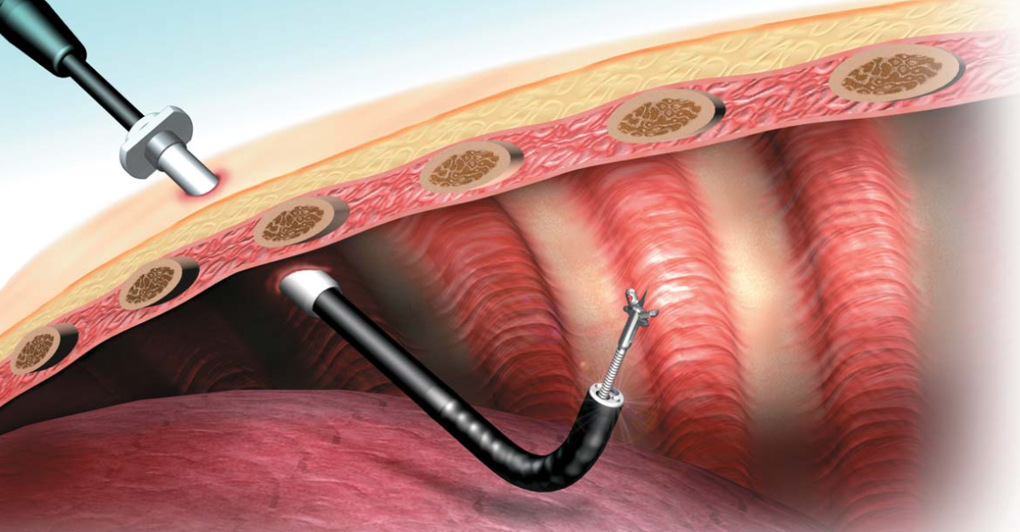 Thoracoscopy procedure